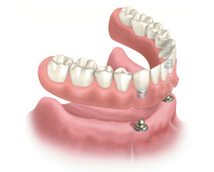 Diagram of an affordable dental implant, which is a snap-on denture hovering above two dental implants in the lower anterior gums and bone.