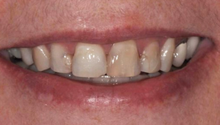 Photo of worn, broken and discolored teeth and bad crowns, which can be used for full-mouth reconstruction from Philadelphia cosmetic dentist Dr. Michael Weiss.