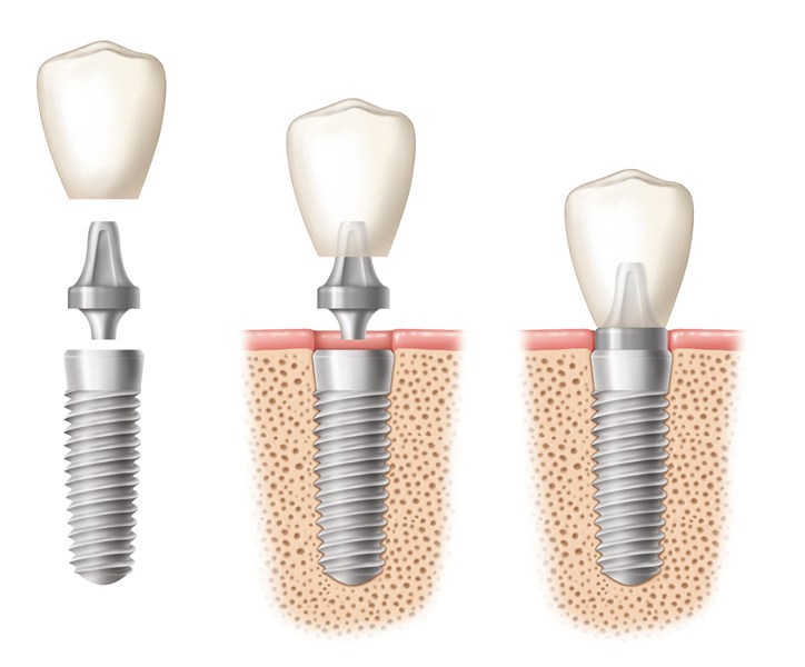 Three stages of a dental implant