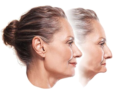 Two profile photos of a woman who experienced jawbone shrinkage and facial collapse, which can be prevented with implant overdentures, available from Philadelphia cosmetic dentist Dr. Michael Weiss.