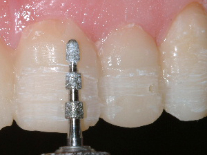 A tooth being prepared for a porcelain veneer