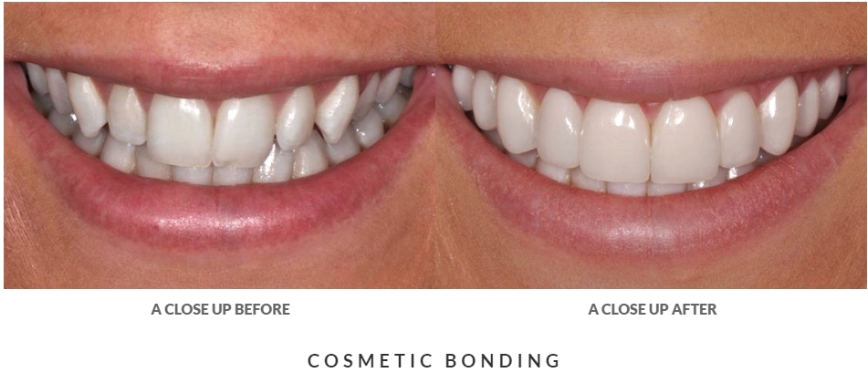before and after dental bonding case