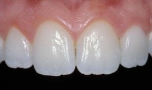 image of a smile after a smile makeover