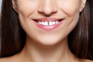 woman smiling with a gap between her two front teeth
