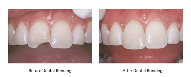 before and after dental bonding to repair a chipped tooth