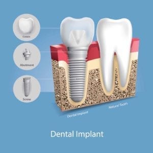 Illustration of a dental implant next to a natural tooth