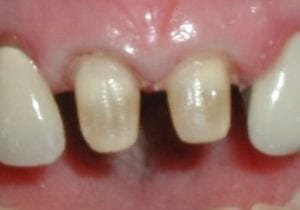 tooth preparation for a porcelain crown