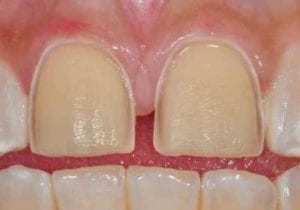 tooth preparation for porcelain veneers