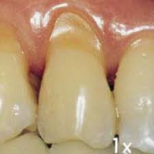 abfraction lesion