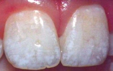 mild fluorosis stains
