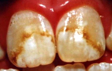 heavier fluorosis stains