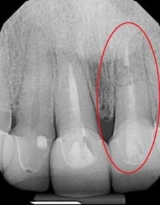 Aaron's Tooth X-ray