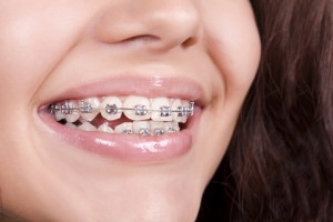 Smile with braces