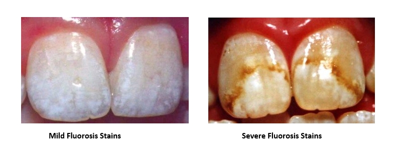 A side by side image of mild and severe fluorosis stains