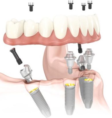 Illustrations of all on 4 dental implants