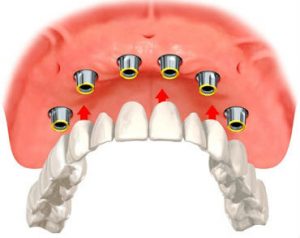 Illustration of dental implant overdentures