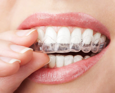 teeth whitening trays being put on teeth