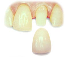 Porcealin crown being placed on a tooth