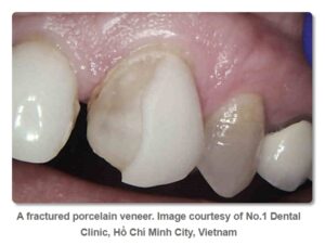 Image of fractured porcelain veneer